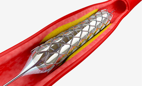 Dilatation peripherer Gefäße