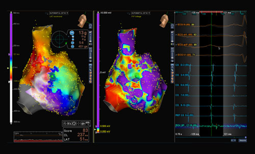 Elektrophysiologische Ablation